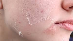 Image result for Dry Skin