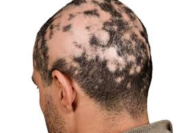 Image result for Alopecia