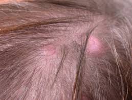 Normally, these cells move up to the surface of the. Trichilemmal Cyst Dermnet Nz