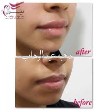 كنتور و تعبئه للشفاه بحقن الفيلر لد د هبه عبدالوهاب للحجز والاستفسار المونسيه 0544229299 Dental Movie Posters Movies