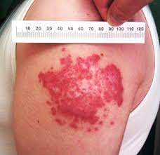 Lupus vulgaris is a painful nodular skin condition most commonly caused by the microorganism mycobacterium tuberculosis. Bcg Induced Lupus Vulgaris An Unexpected Adverse Event Archives Of Disease In Childhood
