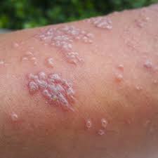 Image result for herpes zoster