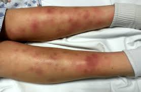 Image result for erythema nodosum