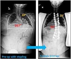 Prader Willi Syndrome Scoliosis And Spine Associates