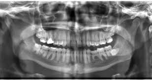 How to take x ray photos. Radiation Exposure From Dental X Rays The Village Dentist