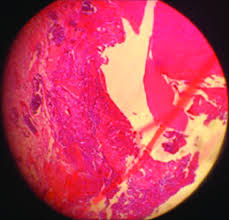 Scattered calcification in congestive pulp in direct pulp capping with...