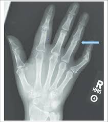 Hand X Ray Suggesting Early Pencil Cup Deformity Download Scientific Diagram