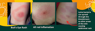 Image result for infected tick bite