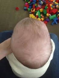 فحص تسطح رأس عند الرضع