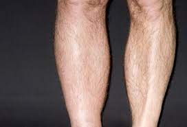 A Visual Guide To Deep Vein Thrombosis Deep Vein Thrombosis Vein Thrombosis Thrombosis