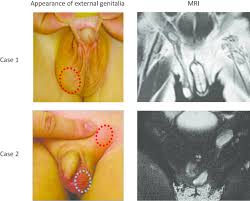 Genetic And Histopathological Analysis Of Transverse Testicular Ectopia Without Persistent Mullerian Duct Syndrome Two Case Reports Journal Of Medical Case Reports Full Text
