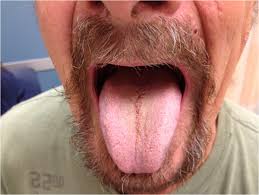 Image result for black hairy tongue symptoms