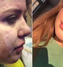 Vitamin a supplements for acne reddit. Vitamin A And Acne Reddit