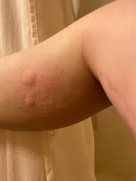 Anyone elses skin do this with mosquito bites? I wear repellant and still  get bit : rlupus