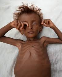 Wider Image: New famine fears loom in Yemen