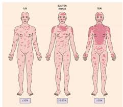 The most common medicines are antibiotics, nsaids, and antiseizure medicines. Stevens Johnson Syndrome And Toxic Epidermal Necrolysis Rush Emergency Medicine