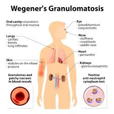 Image result for Vasculitis
