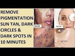 Remove Pigmentation Sun Tan Dark Circles Amp Dark Spots Diy Youtube Sun Tan Pigmentation Remedy How To Remove