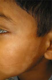 Individuals with such a type of skin disorder can be present in any of the followings stages:. Pityriasis Alba Symptoms Causes Treatment Toronto Dermatology Centre