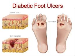 Image result for toe black diabetes