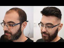 volle haare ohne op zuschauer glucklich machen youtube volleres haar haare haarausfall frauen