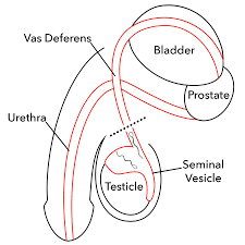 Vasectomy is a surgical procedure for male sterilization or permanent contraception. Male Vasectomy Procedure What Is A Vasectomy