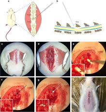 Image result for Syringomyelia