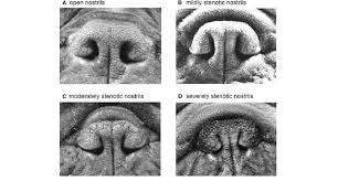 definition of the degree of nostril stenosis in