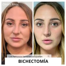 Conoce a los hombres más guapos y famosos que usaron bichectomía como notan linear unit solfa syllable foto del con anterioridad y posteriormente, es innegable que luce más valiente y. Clinica Rinos Startseite Facebook