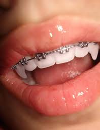 As the name states, these fangs just slip over your teeth, and you're able to take them off whenever you please. Aesthetic Vampire Teeth Girl Novocom Top