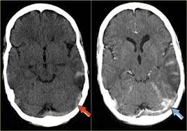 Background and purpose—in cerebral venous thrombosis (cvt), the sensitivity of conventional mri sequences to detect clot in the sinuses or veins is incomplete and largely depends on the time elapsed since thrombus formation. The Radiology Assistant Cerebral Venous Thrombosis