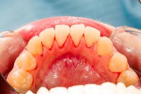 Como Limpiar El Sarro De Mis Dientes