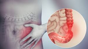 Crampi, diarrea, gonfiore addominale possono essere diminuiti a partire dalla dieta giusta.; Sindrome Del Colon Irritabile Sintomi Cura E Dieta Specifica Parmapress24