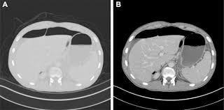 Image result for CT Intravenous Contrast