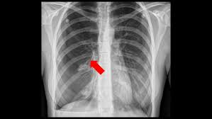 The condition can arise if the chest wall is injured, opened, or if any tear or rupture happens in the pulmonary tissue. Spontaneous Pneumothorax Children S Hospital Of Philadelphia