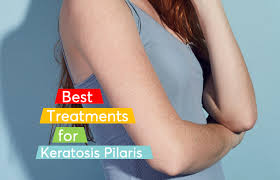 Keratosis Pilaris Best Treatments Mdacne