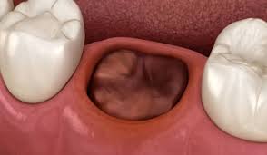 Image result for Dry Socket