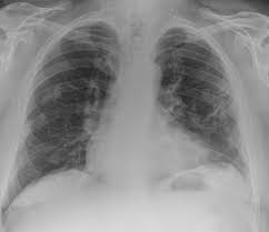 Experience in the field of asbestos related radiological changes. Calcified Pleural Plaques Radiology Case Radiopaedia Org