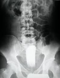 Pin On Urogenital Radiology
