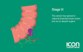 Common symptoms of bowel cancer may include: Colorectal Cancer Signs Symtomps Icon Centre Singapore
