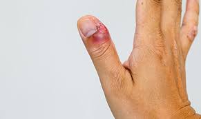 How to remove a splinter | webmd. Nail Conditions Disorders Treatments Advanced Dermatology