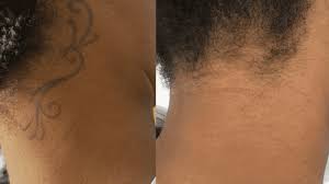 Blisters can appear 8 hours after your laser tattoo removal treatment. Tattoo Removal For Darker Skin London Pulse Light Clinic London