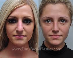 Bulbous nose is neither an inherited trait nor a natural occurrence. Rhinoplasty For A Bulbous Tip Wide Nasal Tip Surgery Funk Facial Plastic Surgery