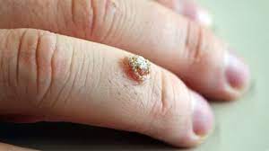 This liquid nitrogen wart removal option may require several sessions, with 1 to 3 weeks between each treatment of wart, in order to be effective. Warts And All What You Need To Know About Warts Ctd