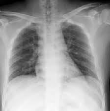 Mesothelioma is cancer of the mesothelium, a membrane that lines the inside of the body's cavities, such as the abdomen or chest. Https Arxiv Org Pdf 2005 11856