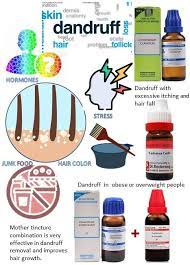 How To Get Rid Of Dandruff With Natural Remedies In 2021 Homeopathy Medicine Alternative Medicine Homeopathy Homeopathy