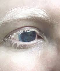 White Eyelashes Blue Eyes Albinism Eyes Albino