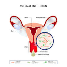 Image result for Vaginitis