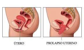 So Enfermagem Prolapso Uterino Prolapso Uterino E A Condicao Em Que O Utero Devido Ao Enfraquecimento Dos Musculos Ligamentos E Membranas Que O Sustentam Desce Da Cavidade Pelvica Para O Canal