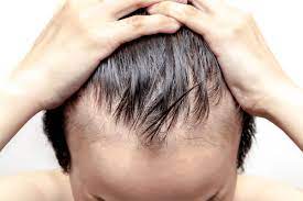 Doctors can perform screenings to determine the possible root cause of the hair loss. Does Wearing A Hat Cause Baldness By All Designer Shit Medium